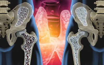 La Relación entre el Hipotiroidismo y la Osteoporosis: Un Vínculo Hormonal