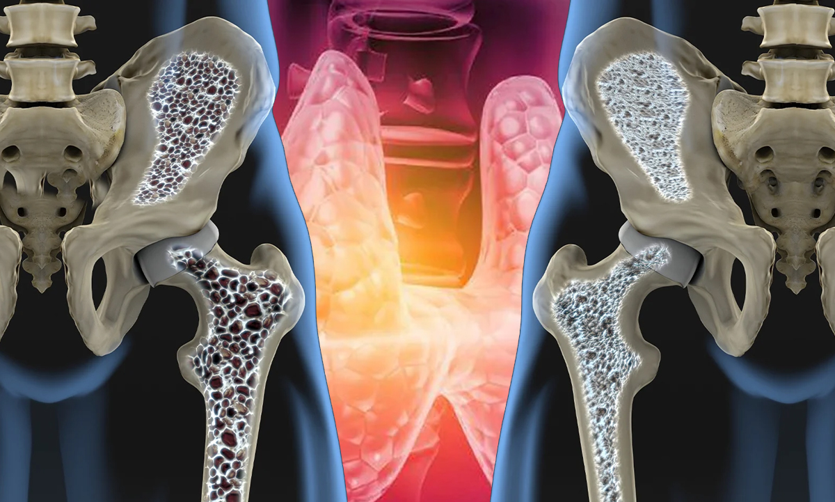 osteoporosis Hipotiroidismo